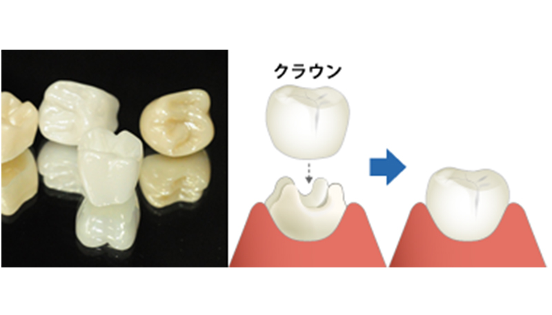 セラミックスクラウン