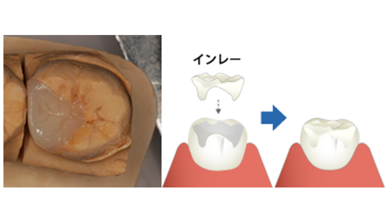 セラミックスインレー